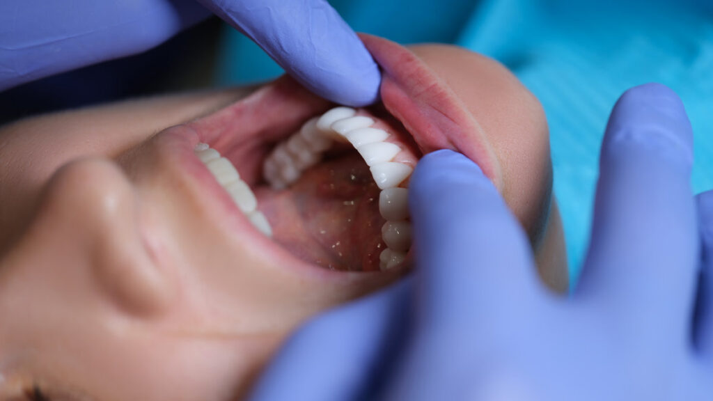Doctor dentist examining patient oral cavity with veneers closeup
